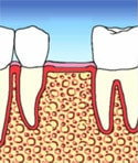 Zahnlücke mit geschlossener Knochensubstanz