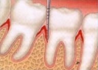 Vereinfachte Darstellung von erkranktem Zahnfleisch